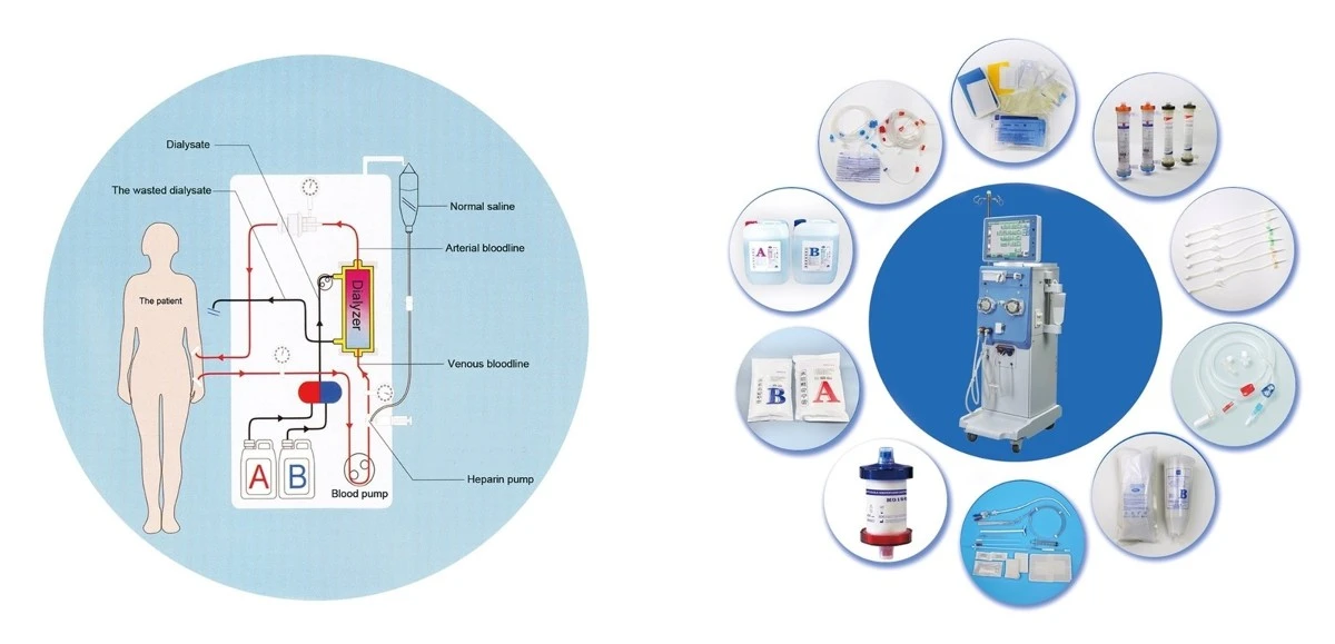 Dialysis Treatment and Dialysis Consumables Dialysis Treatment and Dialysis Consumables